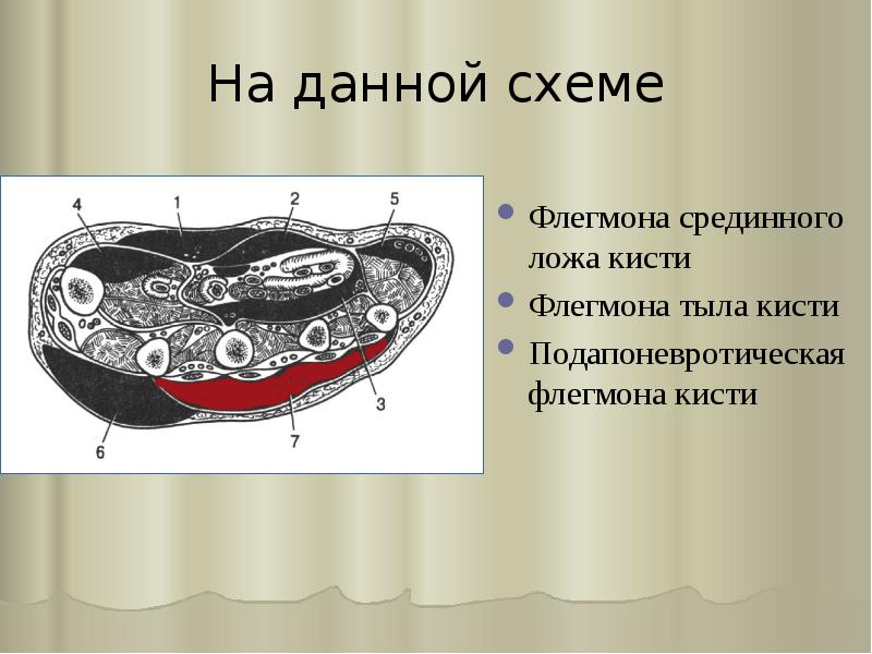 На данной схеме
Флегмона срединного ложа кисти
Флегмона тыла кисти
Подапоневротическая На данной схеме
Флегмона срединного ложа кисти
Флегмона тыла кисти
Подапоневротическая