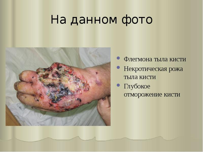 На данном фото
Флегмона тыла кисти
Некротическая рожа тыла кисти
Глубокое На данном фото
Флегмона тыла кисти
Некротическая рожа тыла кисти
Глубокое