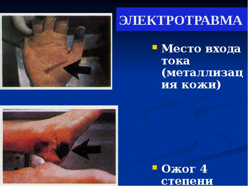 ЭЛЕКТРОТРАВМА
Место входа тока (металлизация кожи)
Ожог 4 степени ЭЛЕКТРОТРАВМА
Место входа тока (металлизация кожи)
Ожог 4 степени