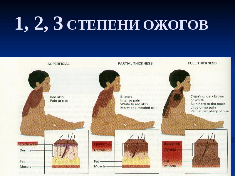 1, 2, 3 СТЕПЕНИ ОЖОГОВ 1, 2, 3 СТЕПЕНИ ОЖОГОВ