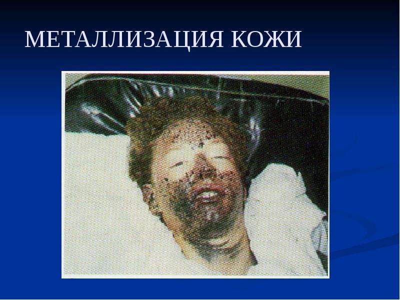 МЕТАЛЛИЗАЦИЯ КОЖИ МЕТАЛЛИЗАЦИЯ КОЖИ