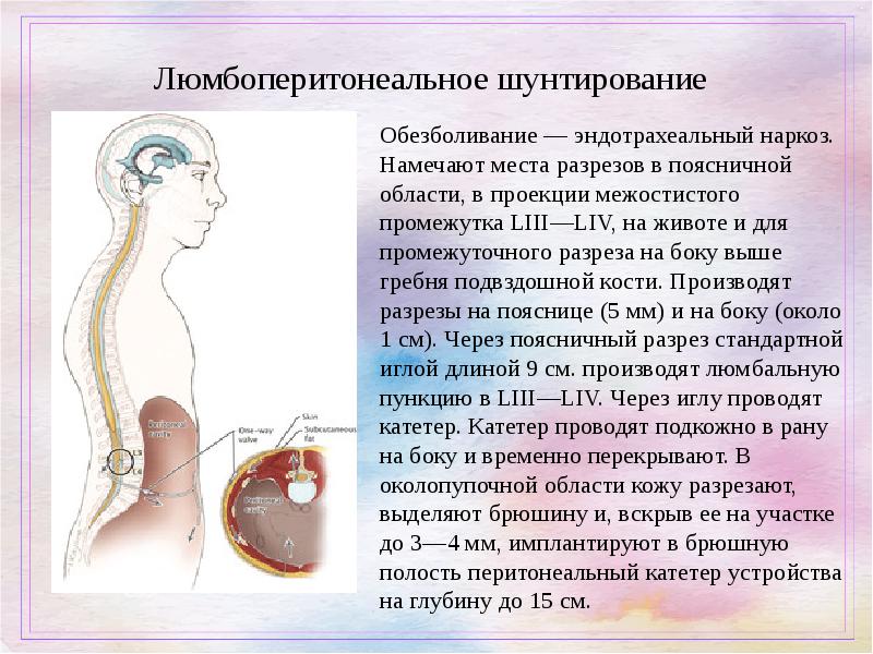 Шунт при гидроцефалии схема