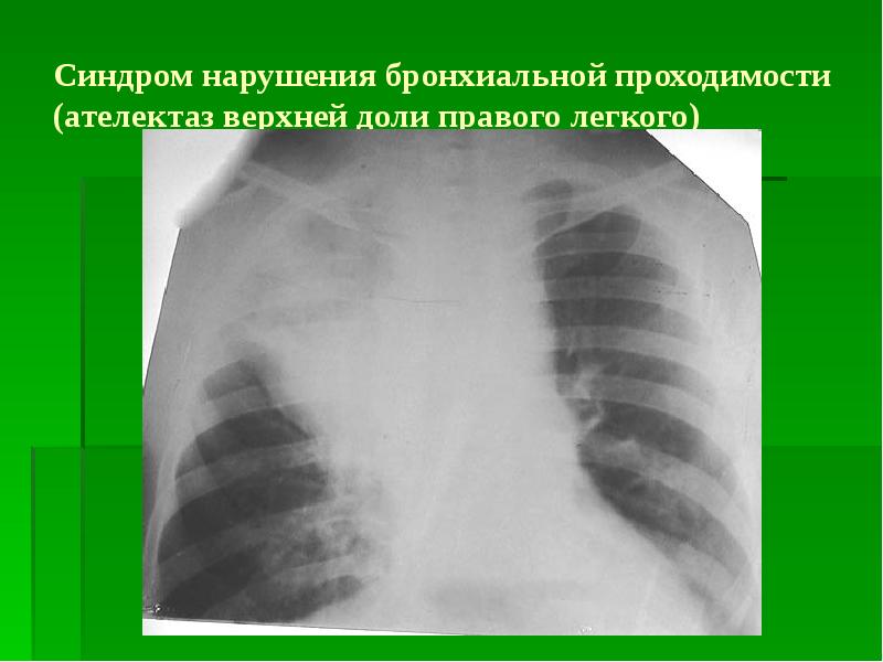 Рентгенологическая картина при коклюше