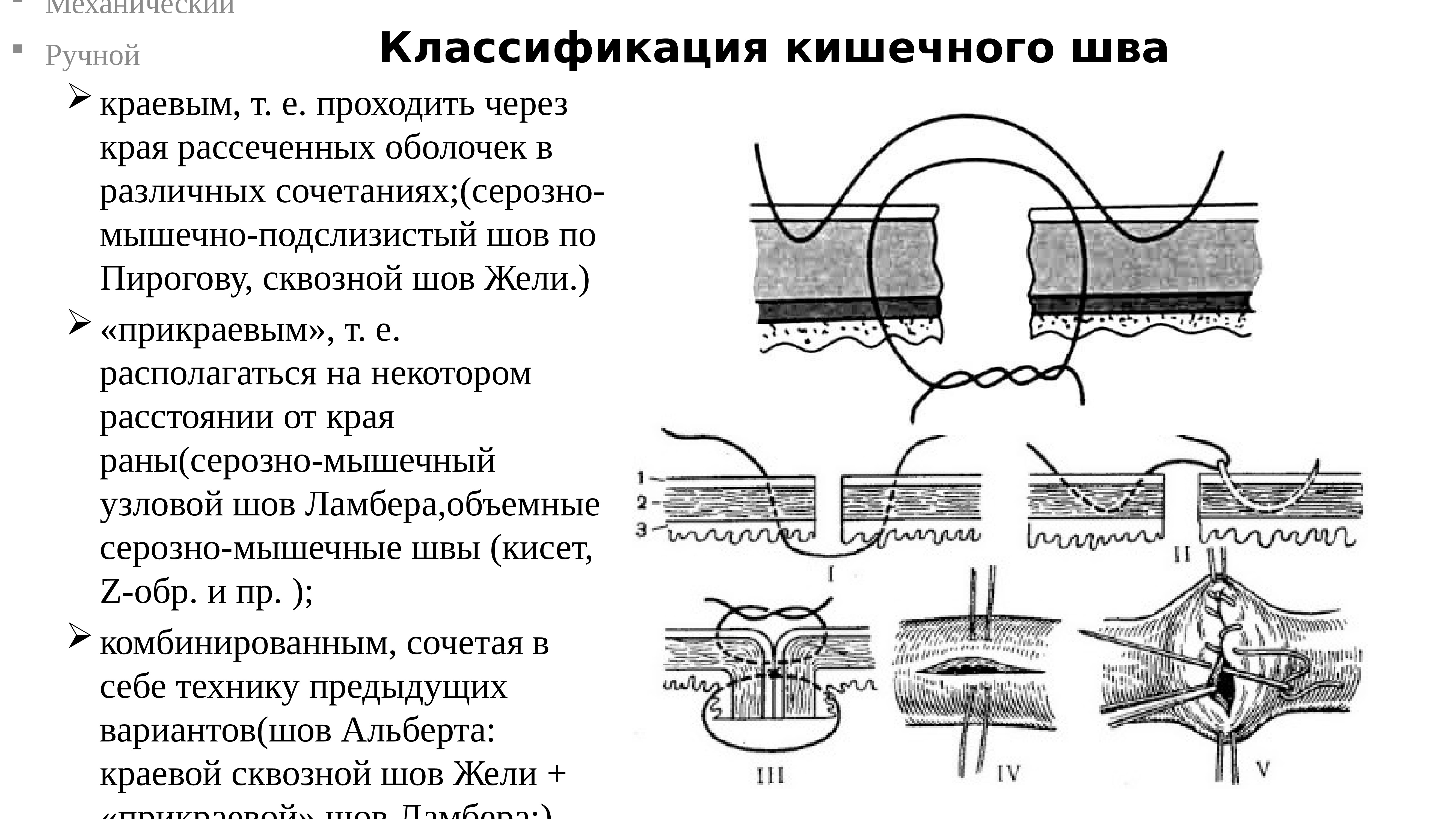 Кишечные швы