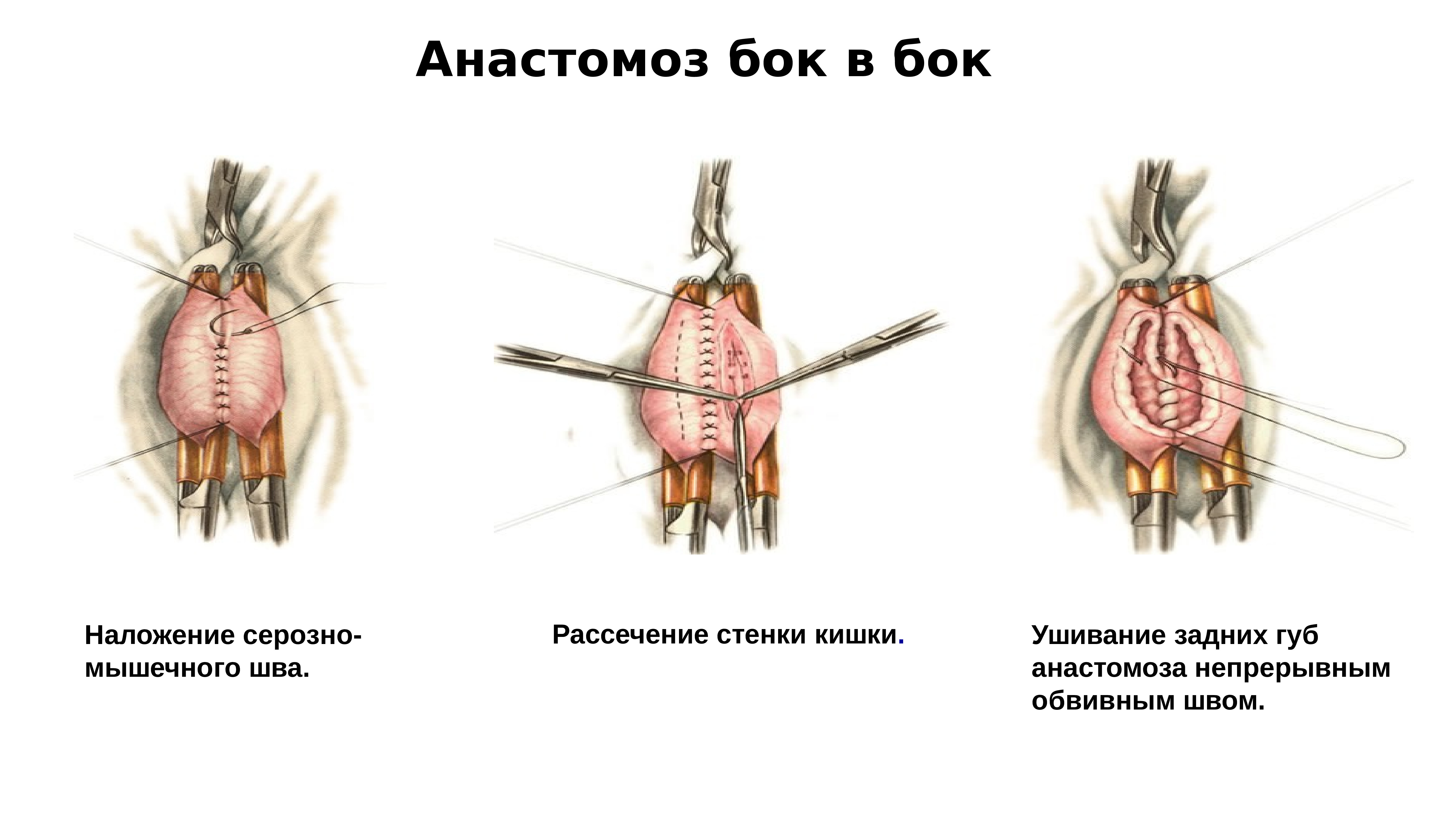 Анастомоз конец в конец схема