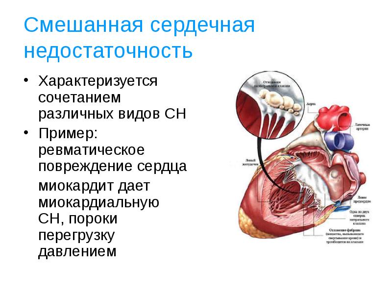 Сочетанный порок сердца