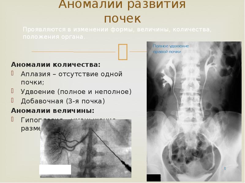 Аномалия развития почек презентация