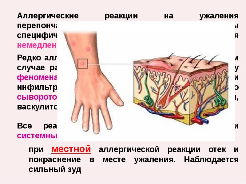 Аллергические реакции при инъекции