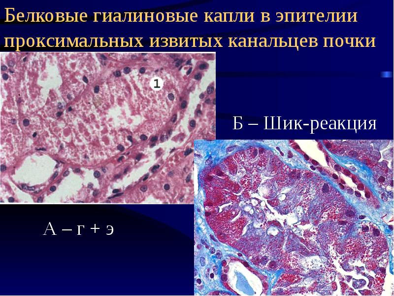 Патологическая анатомия сахарный диабет презентация