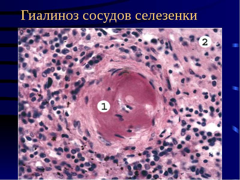 Дистрофии патанатомия презентация