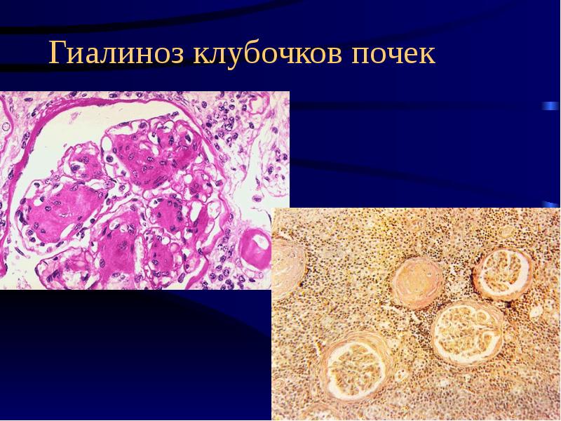 Дистрофии патанатомия презентация