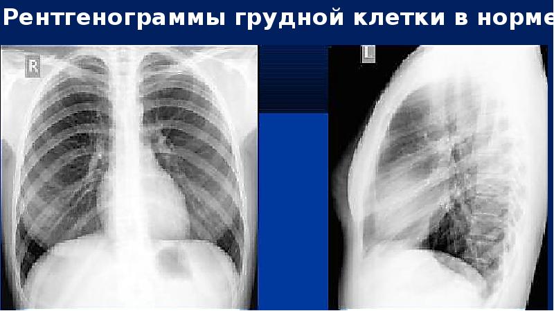 Нагноительные заболевания легких презентация