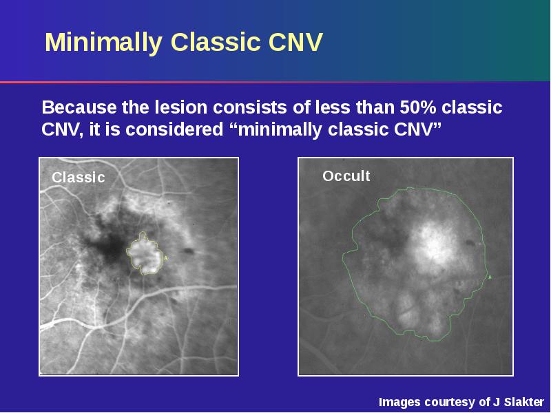 Minimally Classic CNV Minimally Classic CNV