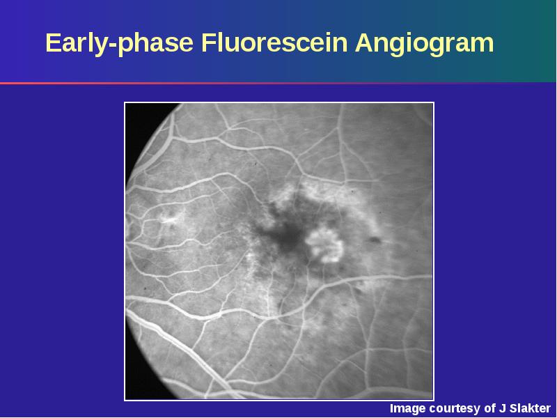 Early-phase Fluorescein Angiogram Early-phase Fluorescein Angiogram