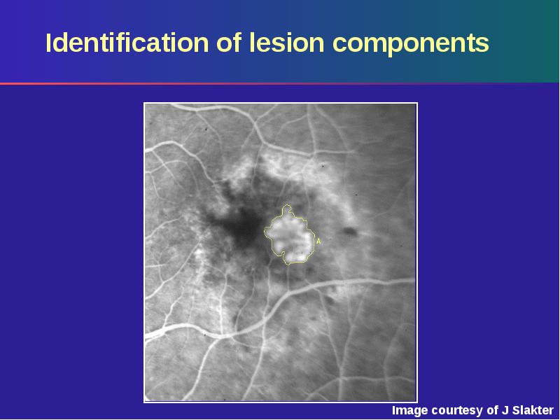 Identification of lesion components Identification of lesion components