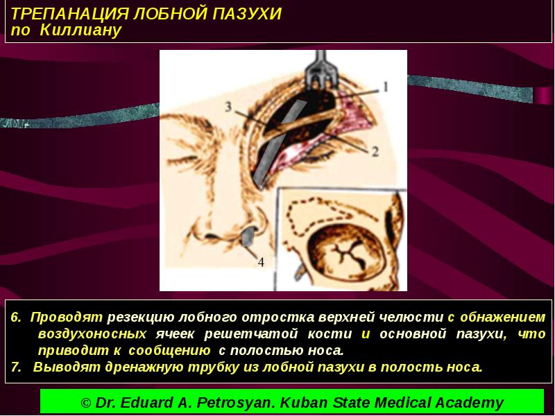 Перелом задней стенки лобной пазухи