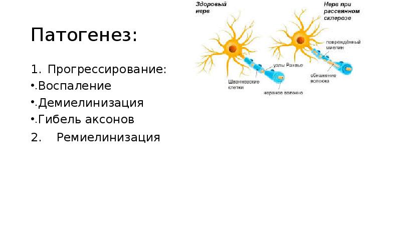 Рассеянный склероз патогенез схема