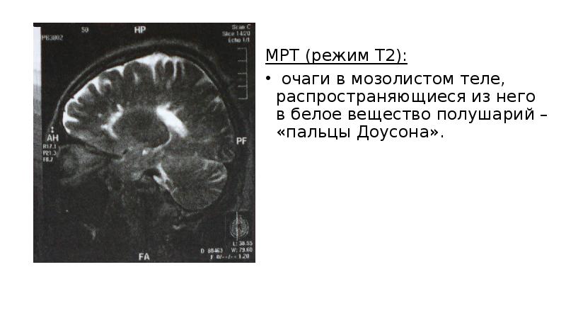 Презентация на тему рассеянный склероз