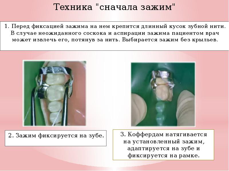 Изоляция рабочего поля в стоматологии презентация