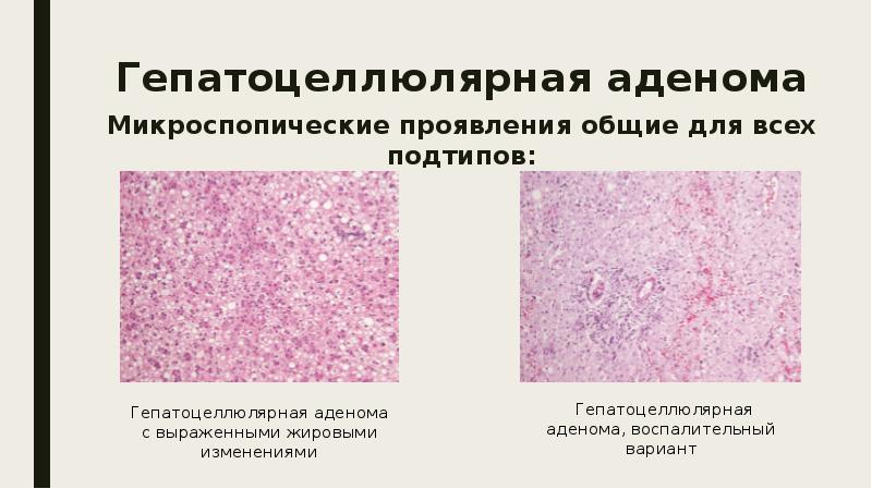 Доброкачественные опухоли печени презентация