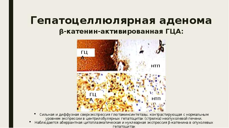 Доброкачественные опухоли печени презентация