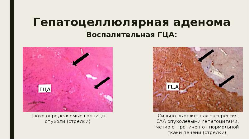 Доброкачественные опухоли печени презентация