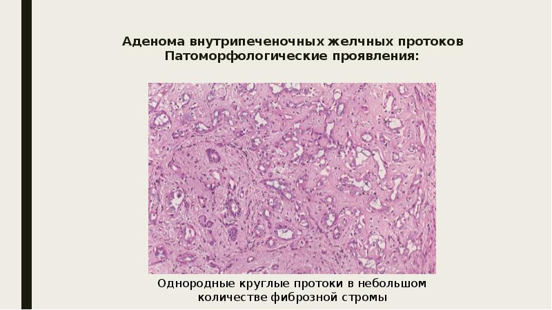 Доброкачественные опухоли печени презентация