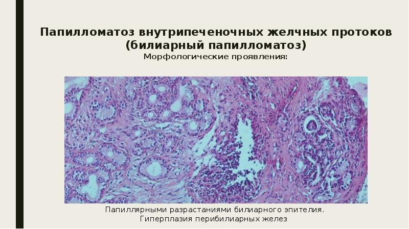 Доброкачественные опухоли печени презентация