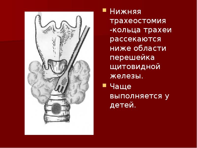 Перешеек щитовидной железы. Трахеостомия верхняя средняя нижняя. Трахеостомия классификация. Техника трахеостомии у детей.