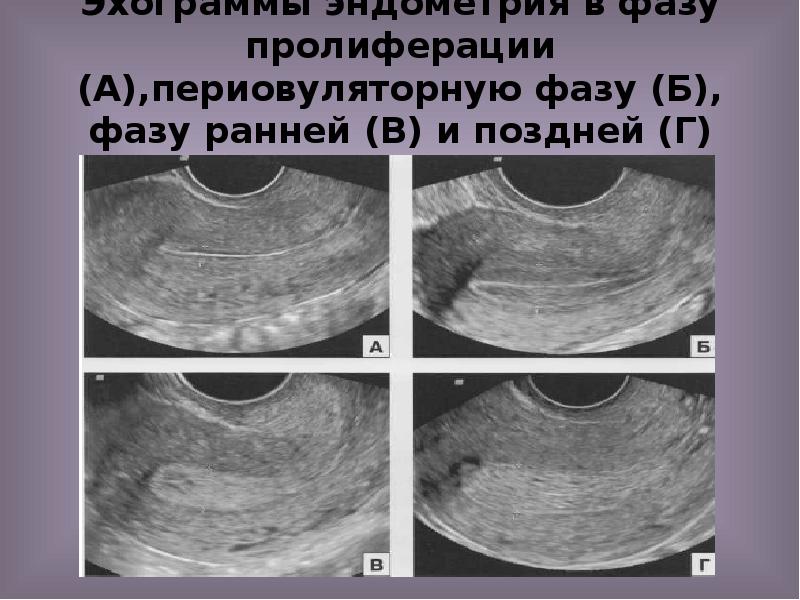 Эхограммы эндометрия в фазу пролиферации (А),периовуляторную фазу (Б), фазу ранней (В) Эхограммы эндометрия в фазу пролиферации (А),периовуляторную фазу (Б), фазу ранней (В)