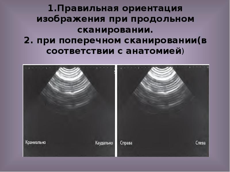 1.Правильная ориентация изображения при продольном сканировании. 2. при поперечном сканировании(в соответствии 1.Правильная ориентация изображения при продольном сканировании. 2. при поперечном сканировании(в соответствии