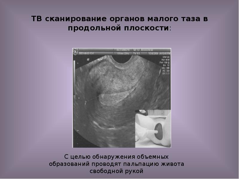 ТВ сканирование органов малого таза в продольной плоскости: ТВ сканирование органов малого таза в продольной плоскости: