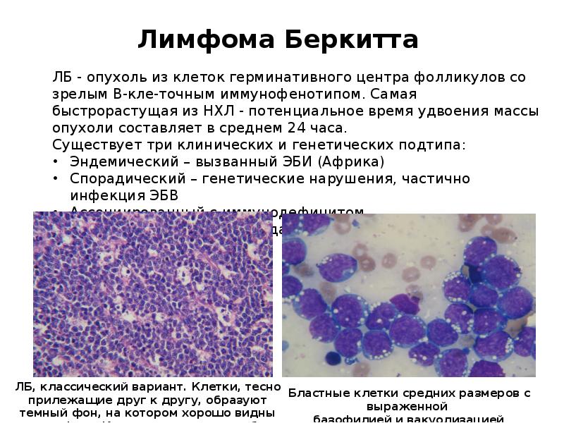 Лимфома лечение. Лимфома Беркитта анализ.