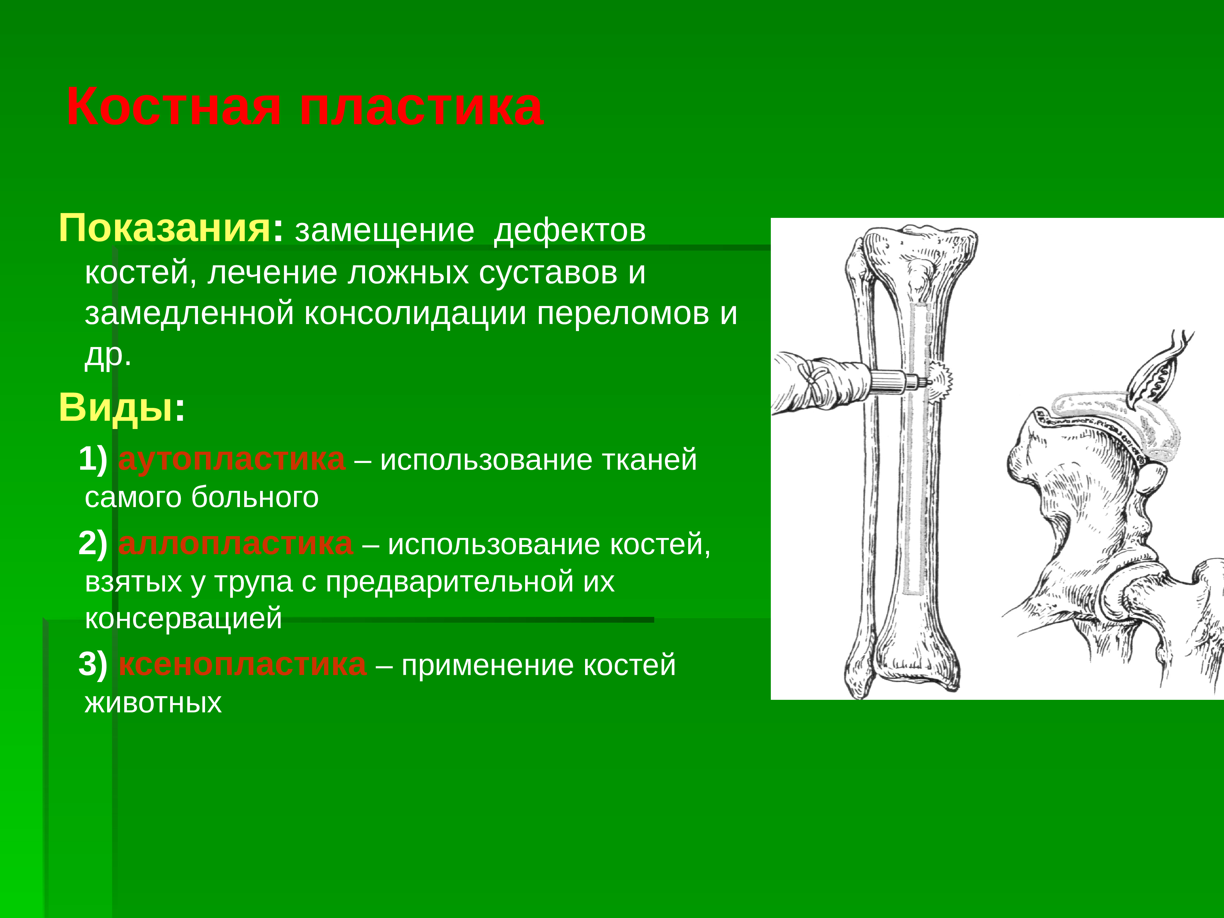 Лечение костей. Костная пластика бедренной кости. Классификация костной пластики. Показания для костной пластики.