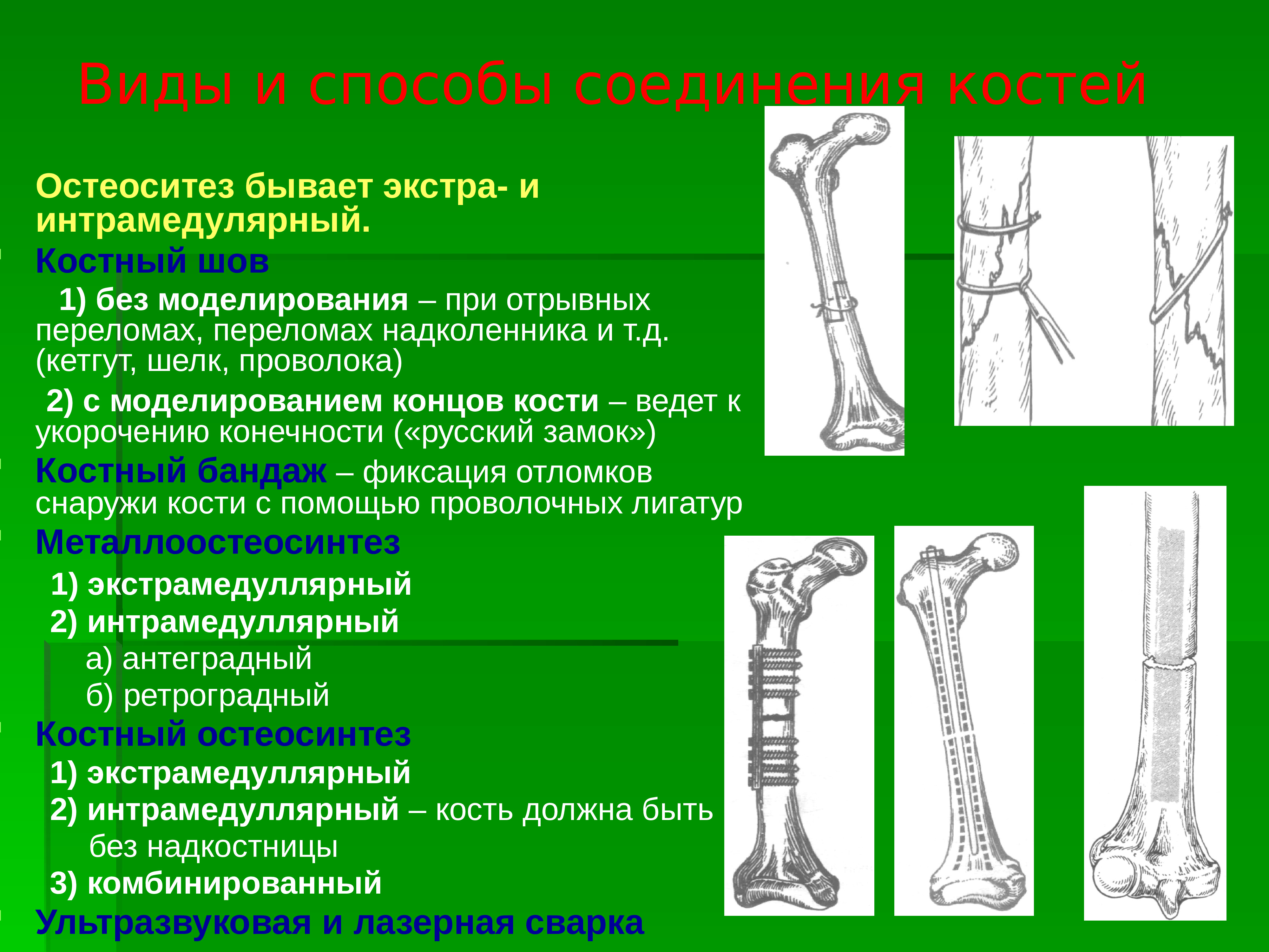 Способы соединения кости. Соединение костей Оперативная хирургия. Способы соединения костных отломков. Способы соединения костей хирургия. Антеградный интрамедуллярный остеосинтез.