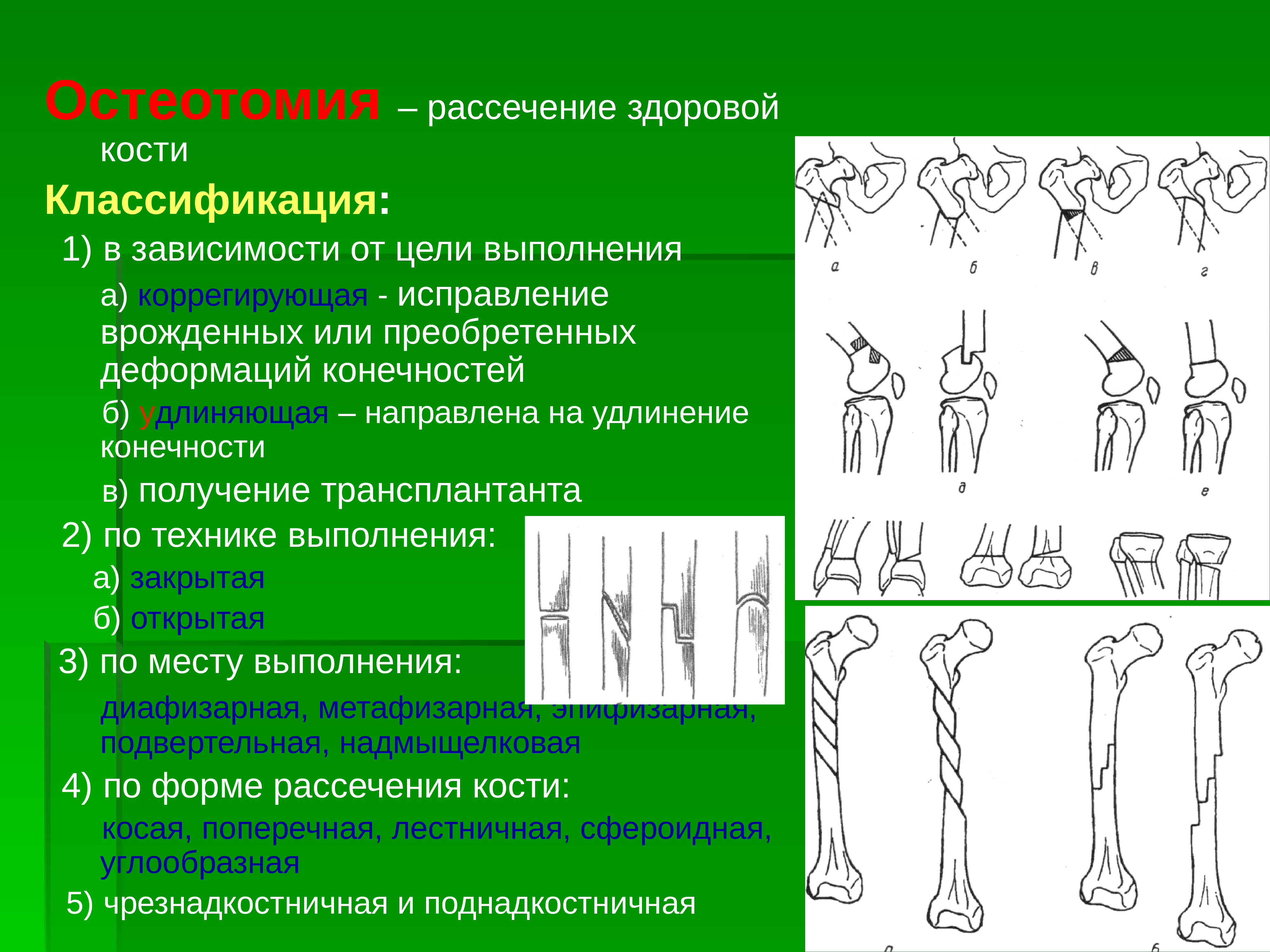 Особенности верхних и нижних конечностей. Остеотомия классификация. Классификация операций на костях и суставах.