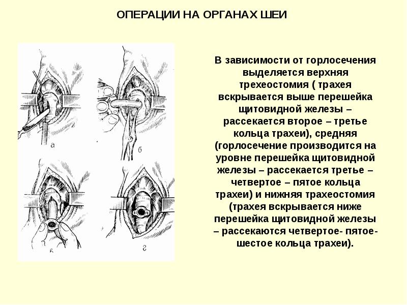 Операции на шее презентация