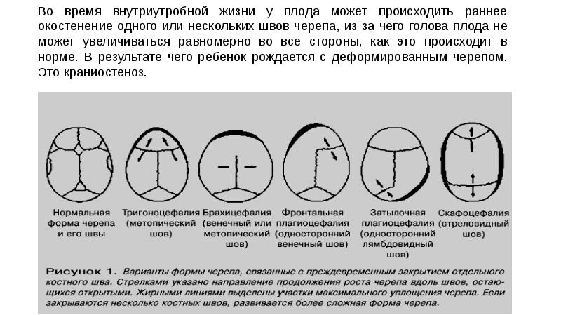 Стреловидный шов фото