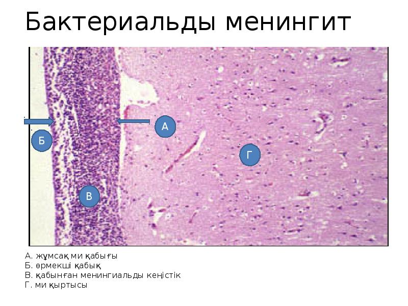 Микроскопическая картина сифилитического энцефалита