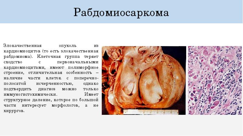 Идиопатический фиброзирующий альвеолит у детей презентация