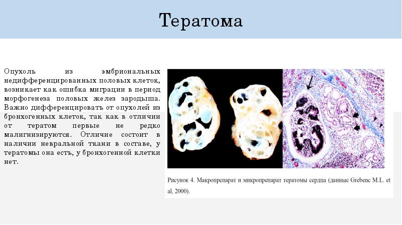 Морфогенез опухоли