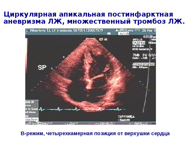 Картине истинной аневризмы в области верхушки миокарда левого желудочка соответствует