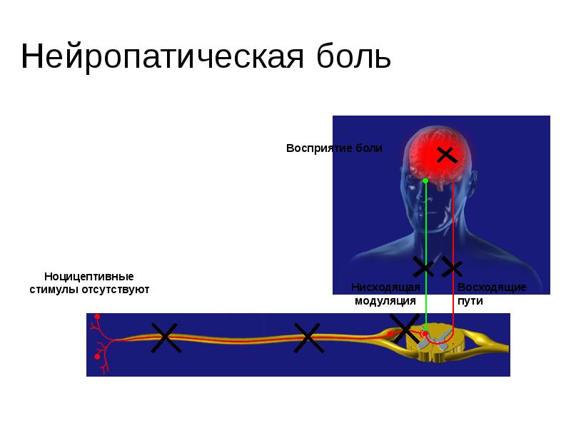 Нейропатическая боль тест нмо