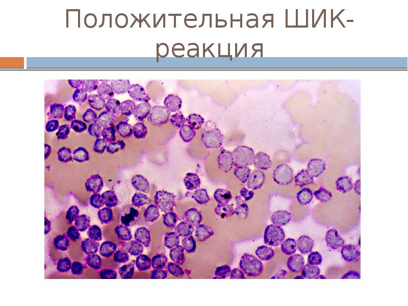 Миелодиспластический синдром презентация