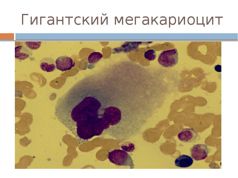 Миелодиспластический синдром презентация