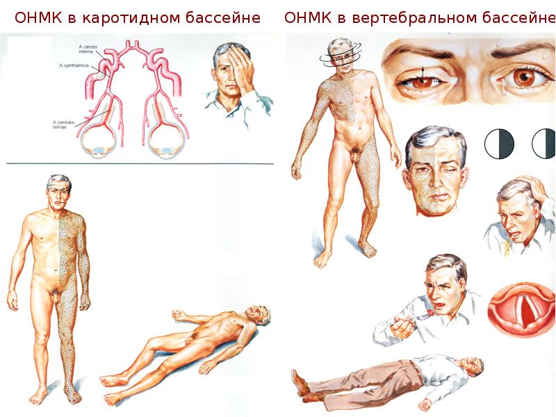 Инсульт презентация неврология