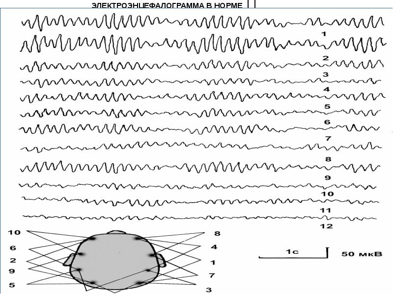 Принцип метода электроэнцефалографии нарисовать и охарактеризовать основные волны ээг