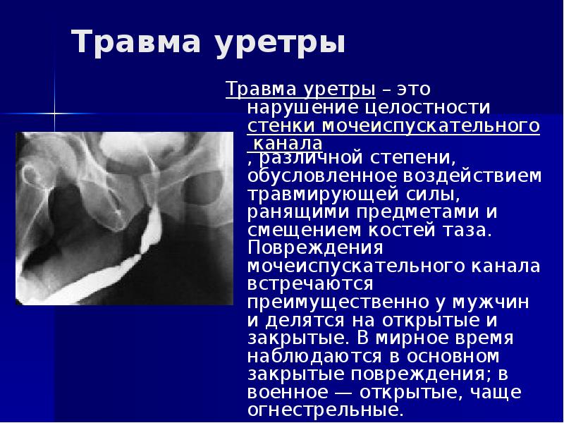 Травма мочеиспускательного канала. Стриктура уретры рентген. Повредил уретру. Уретрография разрыв уретры. Травма уретры диагностика.