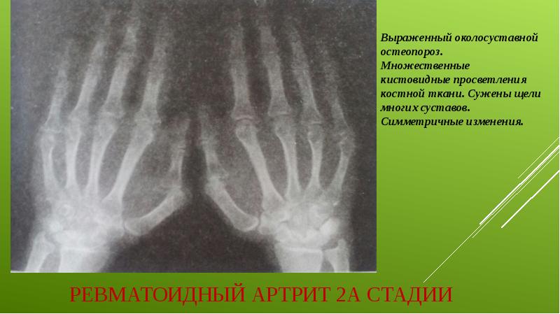 Ревматоидный артрит 2А стадии