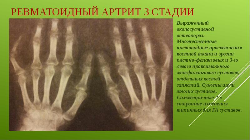 Ревматоидный артрит 3 стадии Выраженный околосуставной остеопороз. Множественные кистовидные просветления костной